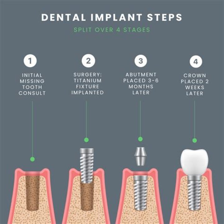 When can I remove my implant?