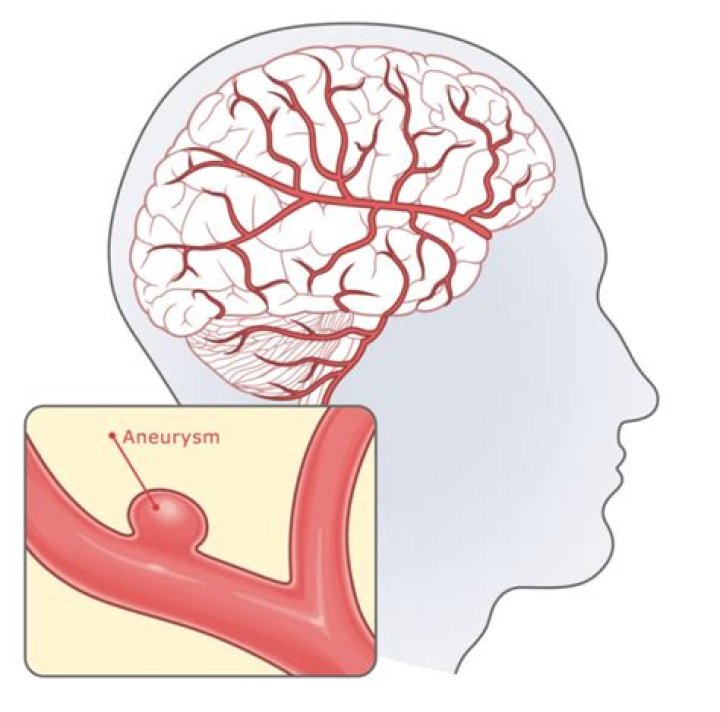 Where do you feel aneurysm?