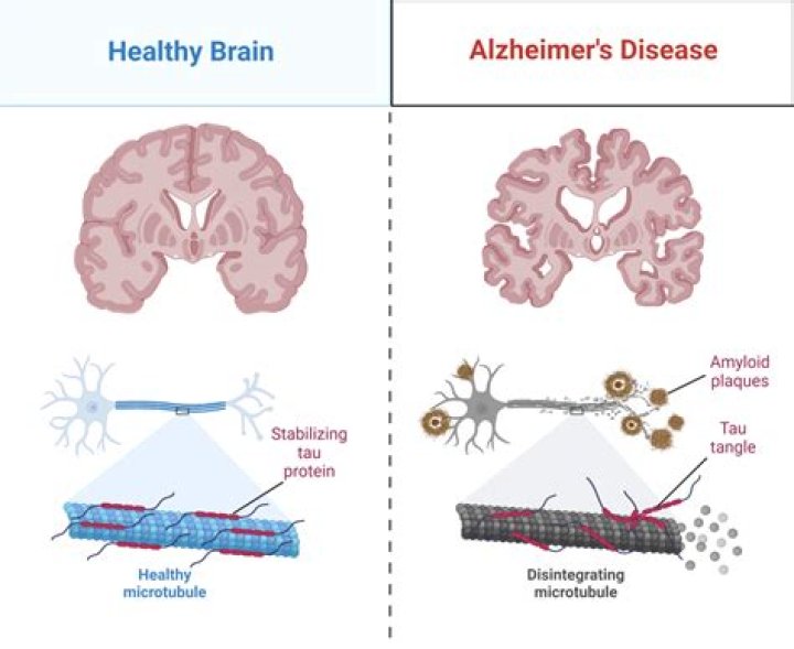 Why do Alzheimer's patients not sleep at night?